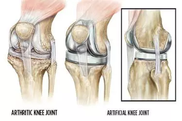 Best doctor for knee replacement in Gurgaon 