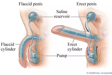 best doctor for penile implant surgery in india, dr deepanshu gupta for penile implant surgery, best doctor for ed treatment in india, best hospital for penile implant surgery in india, cost of penile implant surgery, sethi hospital gurgaon