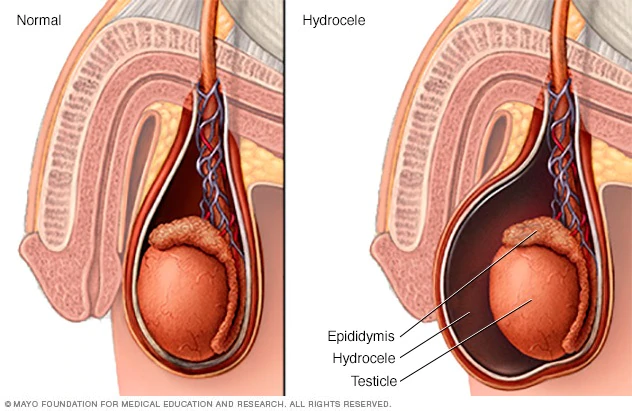 best doctor for hydrocele treatment in gurgaon, best hospital for hydrocele treatment, treatment for pain in the testes, testis swelling treatment in gurgaon
