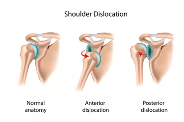 best doctor for shoulder dislocation treatment in gurgaon, best doctor for hip joint dislocation in gurgaon, best hospital for treatment of joint dislocation in gurgaon