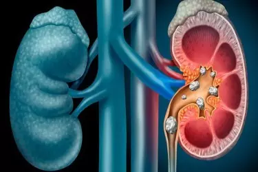 best doctor for kidney stones treatment in Gurgaon