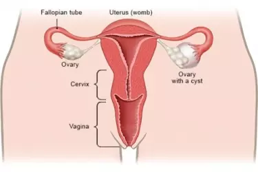 best doctor for ovarian cyst treatment in gurgaon