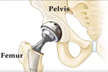 best doctor for hip replacement in Gurgaon